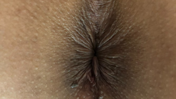 Human anus.jpg - Wikimedia Commons